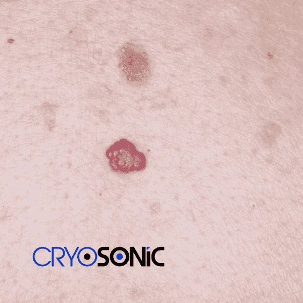 Looking for pain free cherry angioma removal treatment Dewsbury? Call our team today! Dewsbury