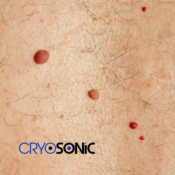 get cherry angioma removal treatment today! Dewsbury