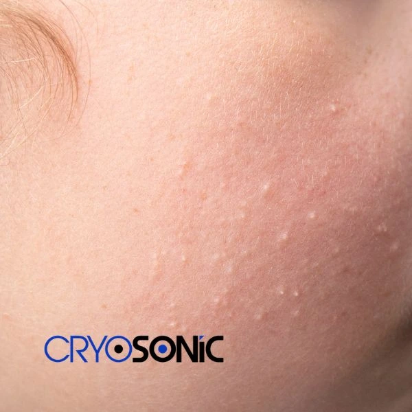 Are you looking for milia removal treatment? Contact our team today Dewsbury