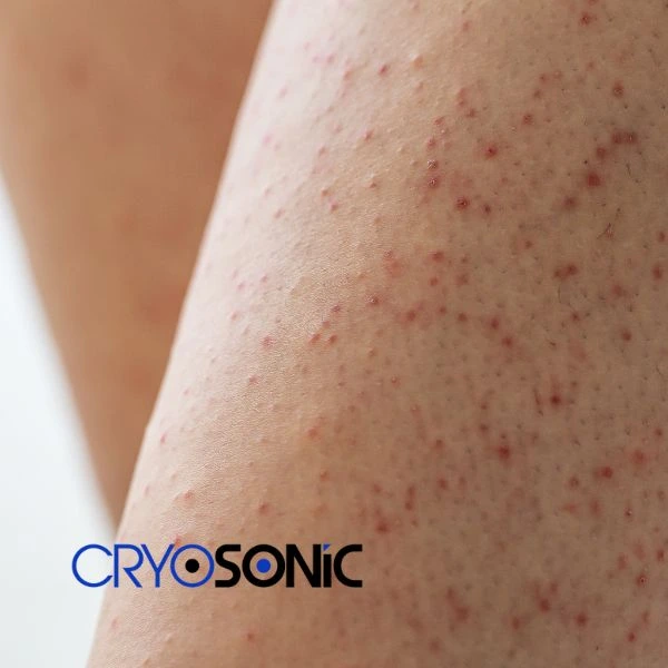 Looking for Seborrhoeic Keratosis removal Dewsbury treatment? Call our consultants today in Dewsbury