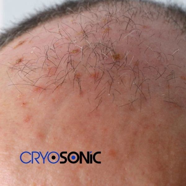Access Seborrhoeic Keratosis removal from the comfort of your own home! Call us today in Dewsbury