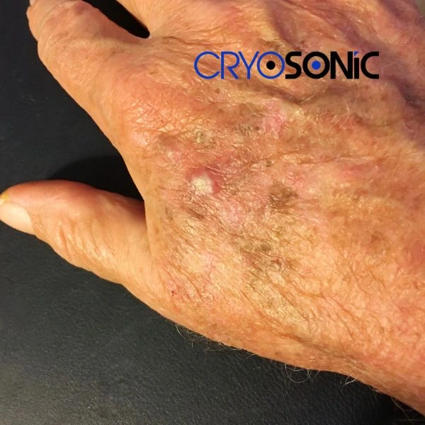 Understand more about actinic keratosis treatment today Dewsbury