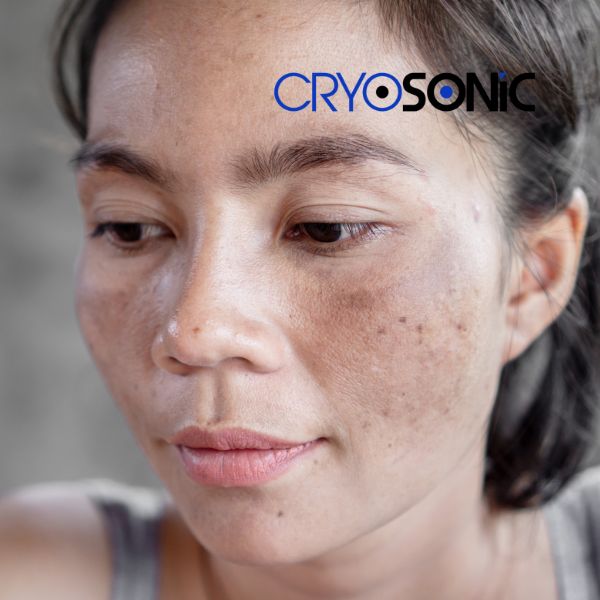 Ready to start age spots removal? Contact our team today in Dewsbury