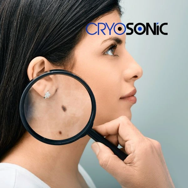 Do you want to learn more about benign moles removal treatment? Call our team today Dewsbury