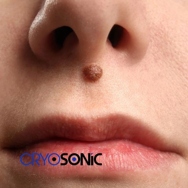 Start your benign moles removal treatment today Dewsbury