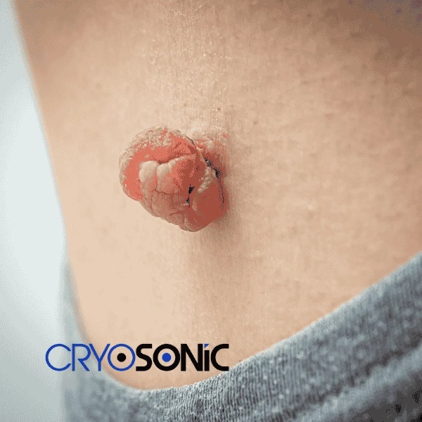 Book your skin tags removal Dewsbury from comfort of your own home! Dewsbury