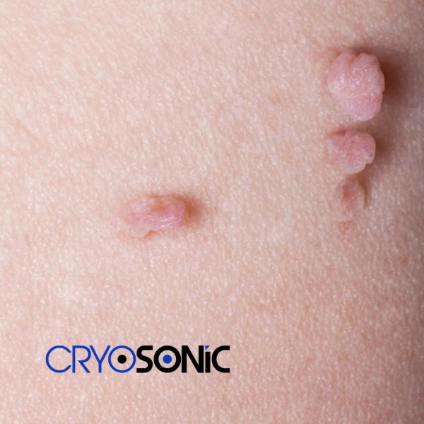 Are you looking for fast effect skin tag removal Dewsbury? Book in NOW! Dewsbury