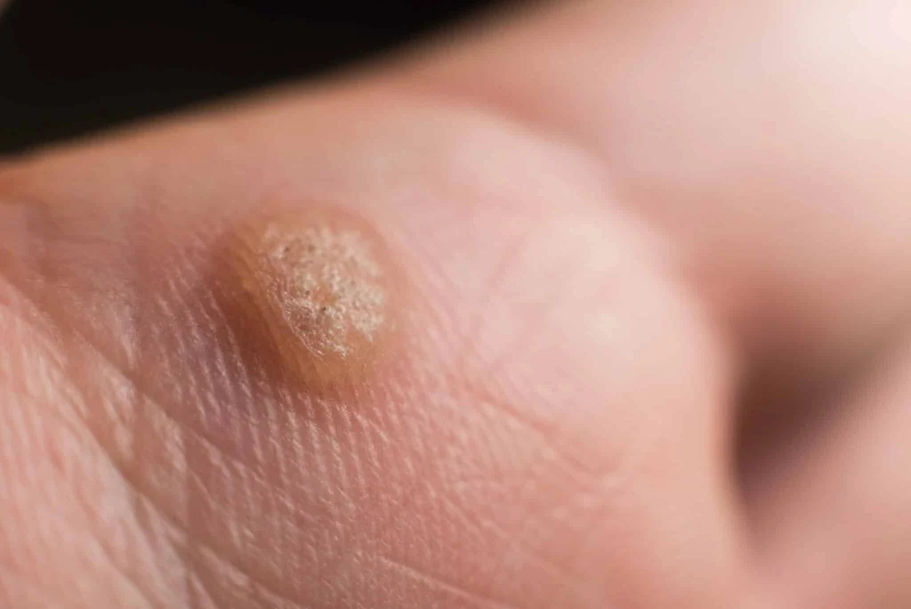 CryoPen treatment for Common Warts showing precise freezing of viral skin lesions for safe and effective removal Dewsbury
