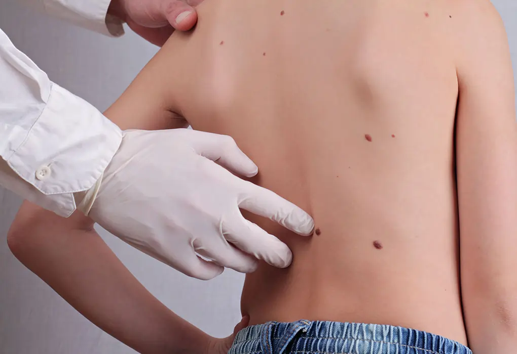 Safe Ways to Remove Skin Tags in Children Dewsbury
