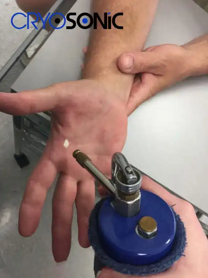 Temperature Differences: OTC vs Medical-Grade Cryotherapy Dewsbury